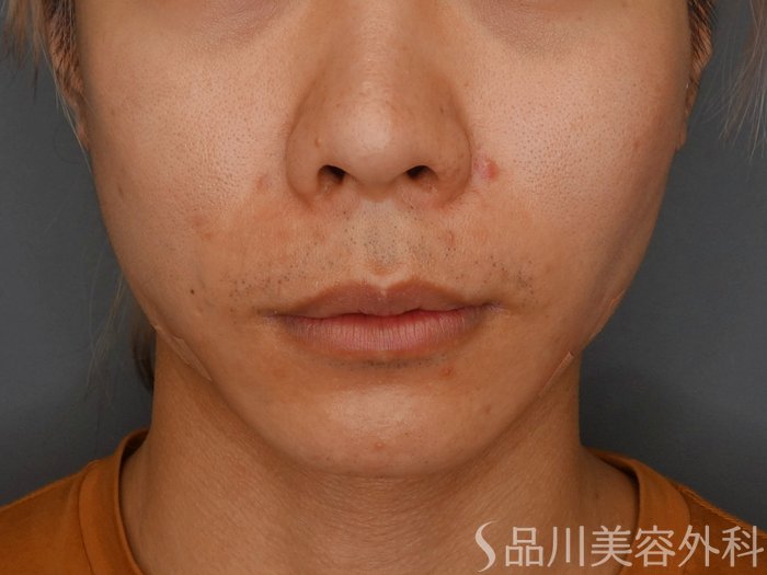 症例NO.73755のAFTER写真