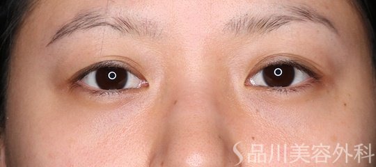症例NO.74715のAFTER写真