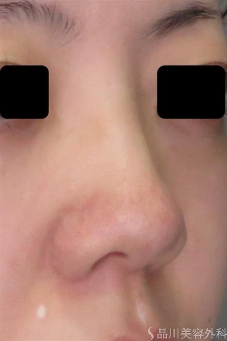 症例NO.48824のBEFORE写真