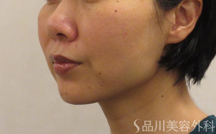症例NO.69661のBEFORE写真