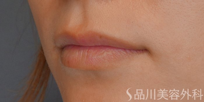 症例NO.71620のBEFORE写真