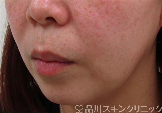 症例NO.35160のBEFORE写真