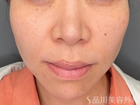 症例NO.74703のBEFORE写真