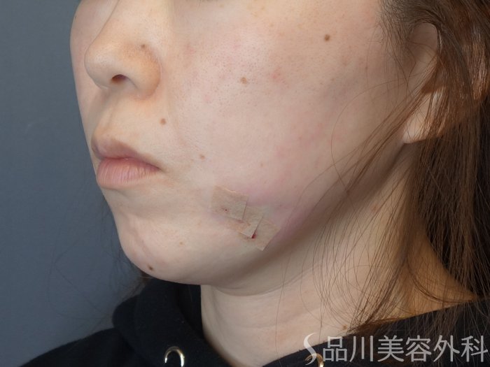 症例NO.73456のAFTER写真