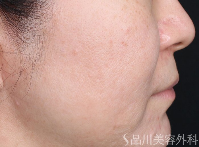 症例NO.73230のAFTER写真