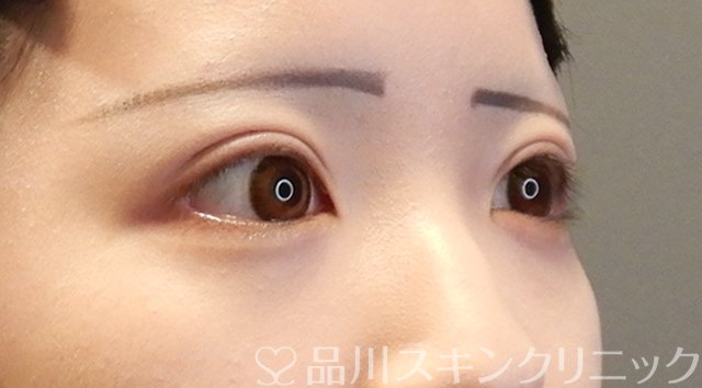 症例NO.66011のAFTER写真