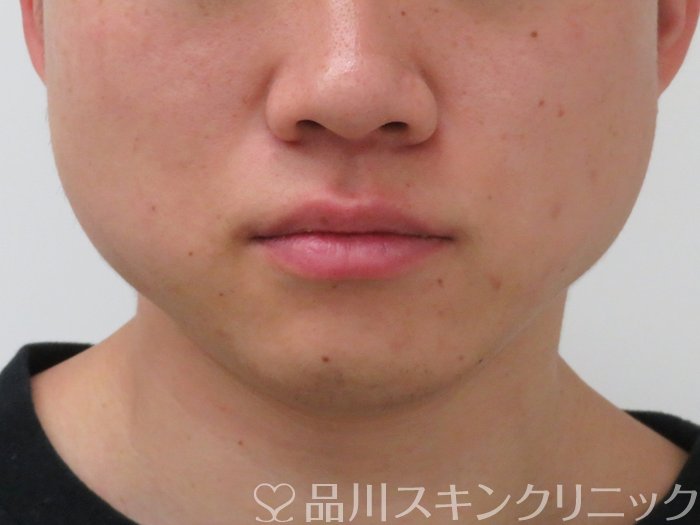 症例NO.65822のBEFORE写真