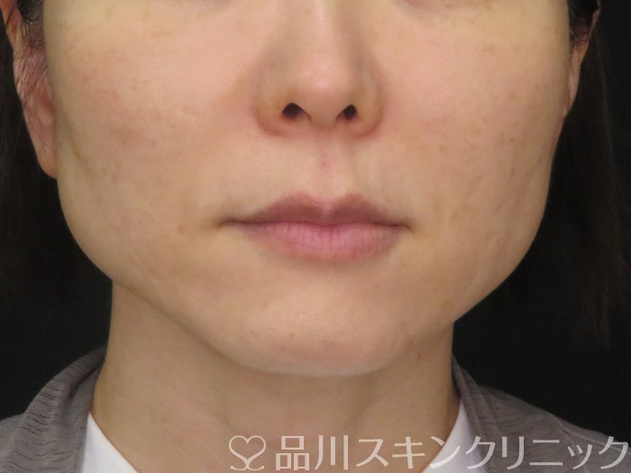 症例NO.70603のAFTER写真