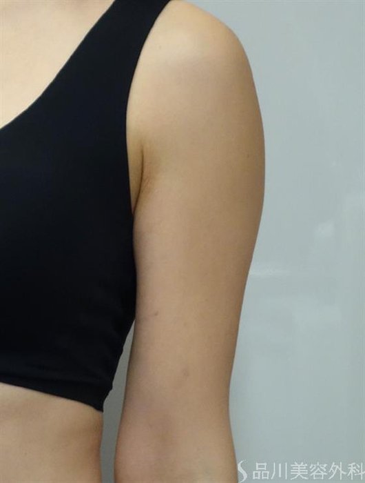 症例NO.42214のBEFORE写真