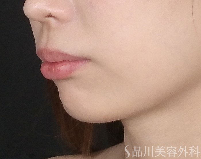 症例NO.65393のBEFORE写真