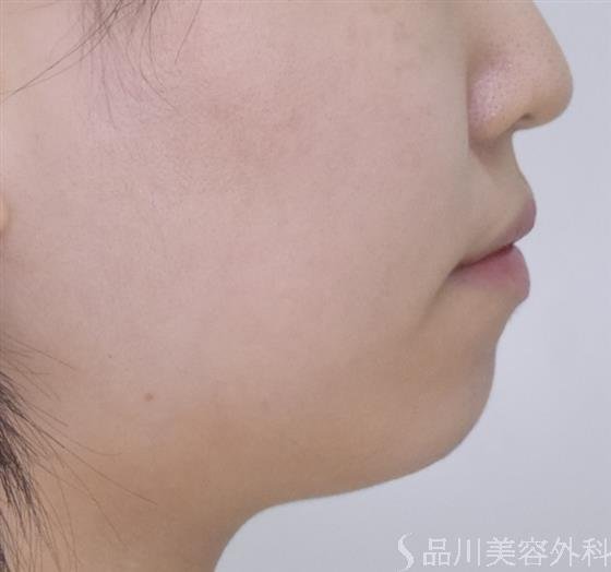 症例NO.50066のBEFORE写真