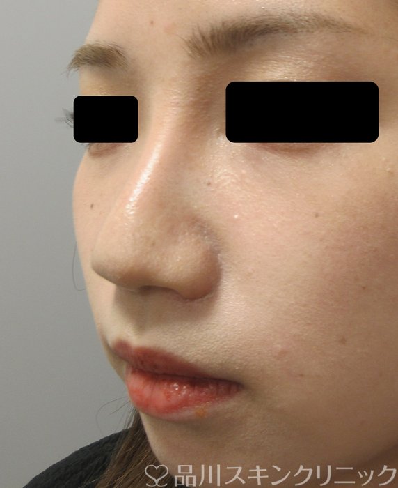 症例NO.72940のAFTER写真