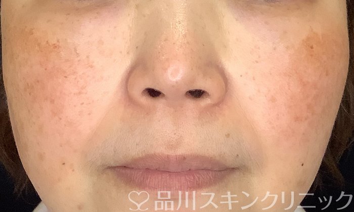 症例NO.73921のAFTER写真
