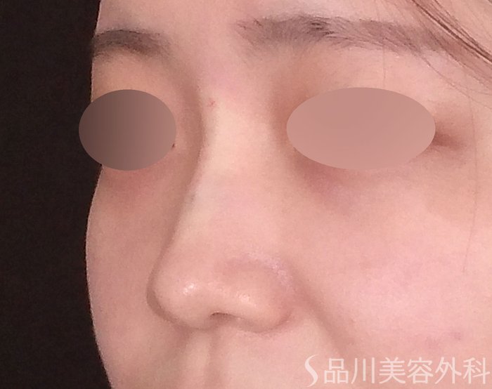 症例NO.70285のAFTER写真