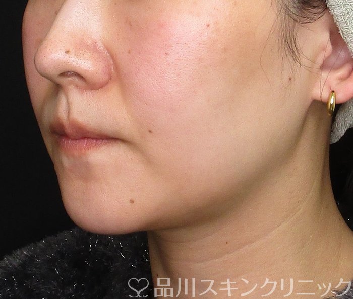 症例NO.72775のBEFORE写真