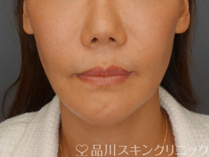 症例NO.71698のBEFORE写真