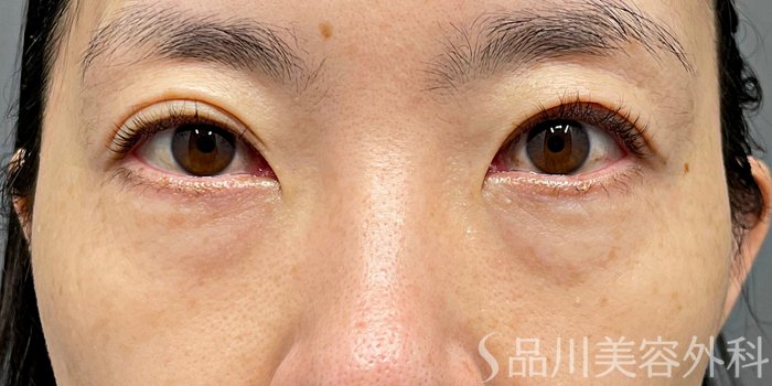 症例NO.74872のBEFORE写真