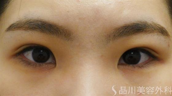症例NO.56141のAFTER写真