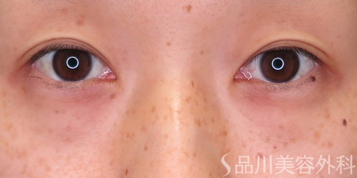 症例NO.71289のBEFORE写真