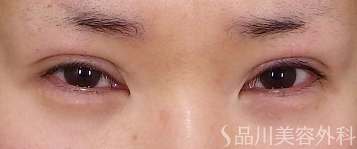 症例NO.72153のAFTER写真