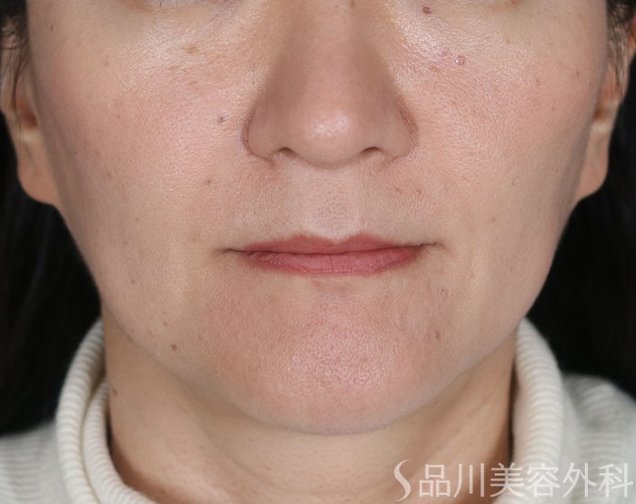 症例NO.72490のAFTER写真