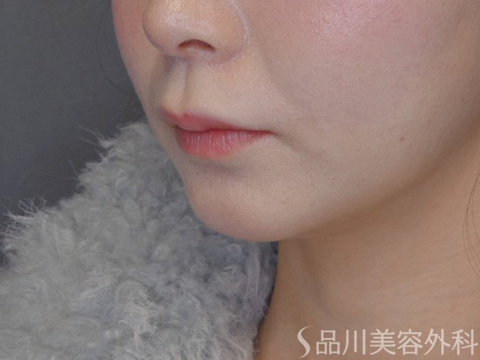 症例NO.72406のBEFORE写真