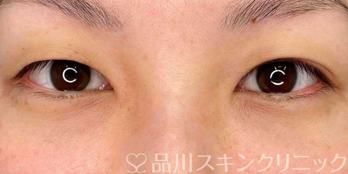 症例NO.65525のBEFORE写真