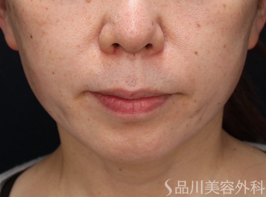 症例NO.73098のAFTER写真