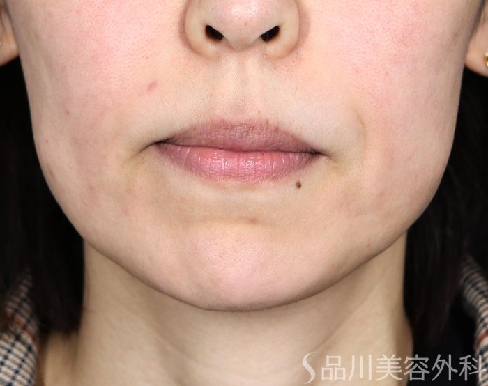 症例NO.74121のBEFORE写真