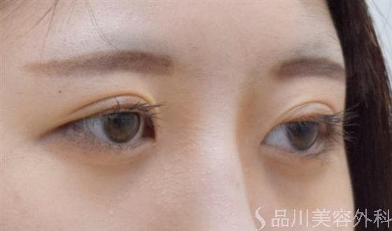 症例NO.58670のAFTER写真