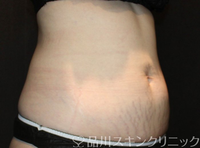 症例NO.72437のAFTER写真