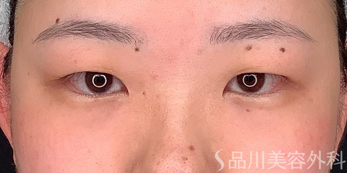症例NO.71234のBEFORE写真