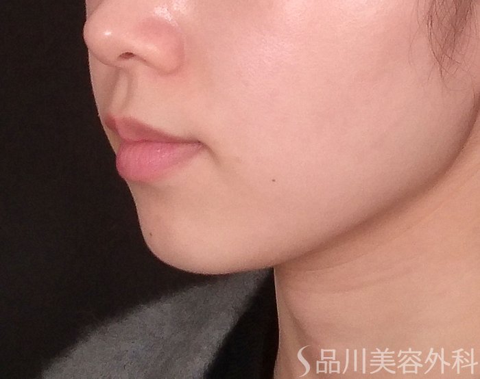 症例NO.69328のBEFORE写真