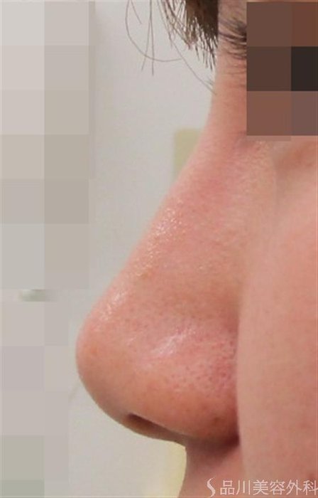 症例NO.43592のBEFORE写真