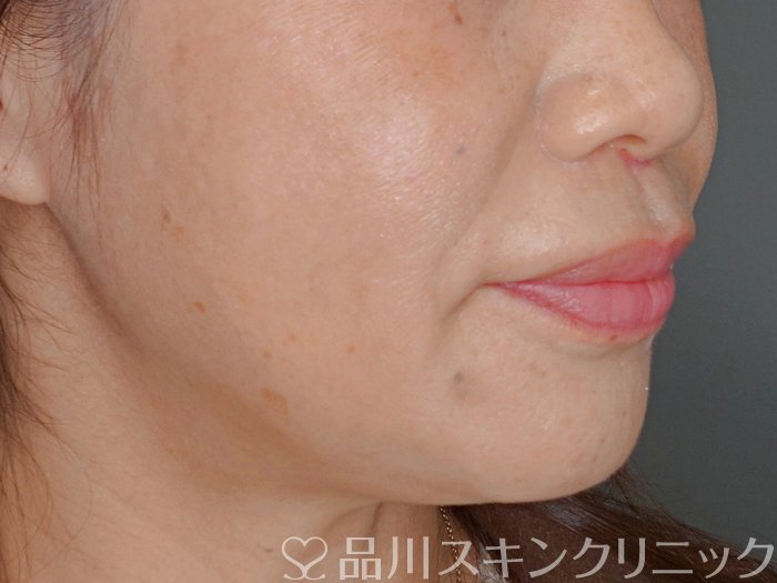 症例NO.73658のBEFORE写真