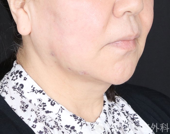 症例NO.73691のAFTER写真