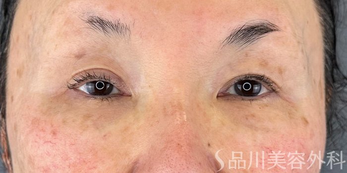 症例NO.72837のBEFORE写真