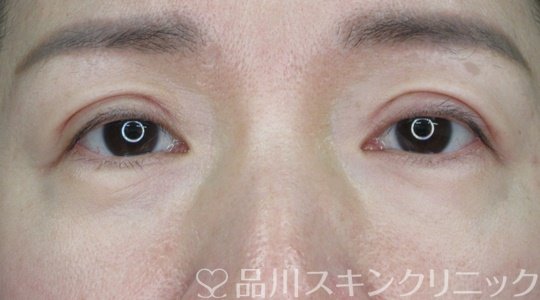 症例NO.69463のAFTER写真
