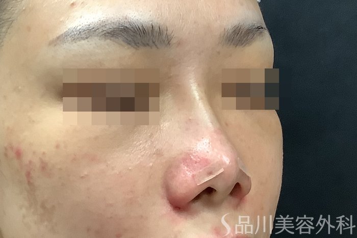 症例NO.71638のAFTER写真