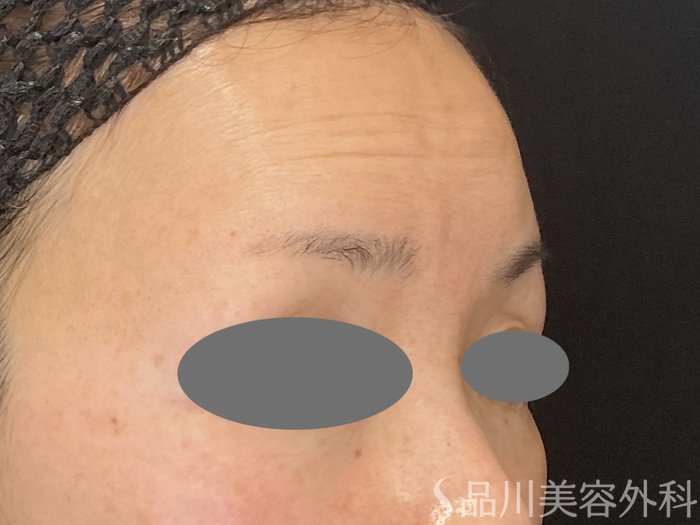 症例NO.72995のAFTER写真