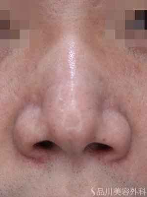 症例NO.74286のBEFORE写真