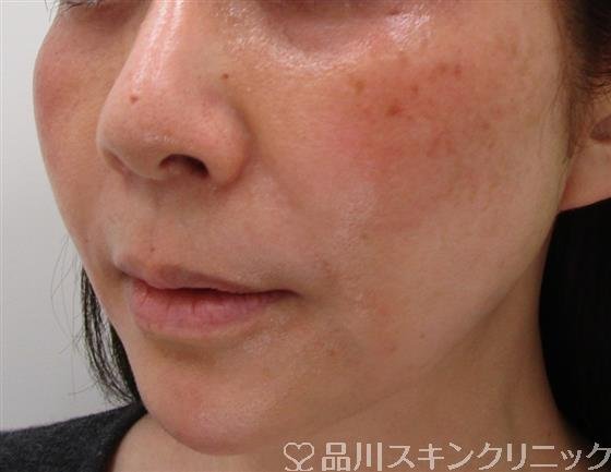 症例NO.34889のAFTER写真