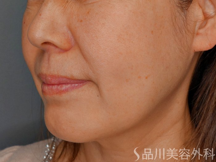 症例NO.73278のBEFORE写真