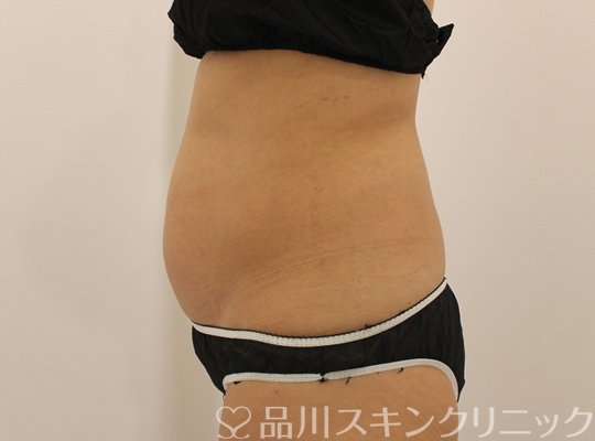 症例NO.74864のBEFORE写真