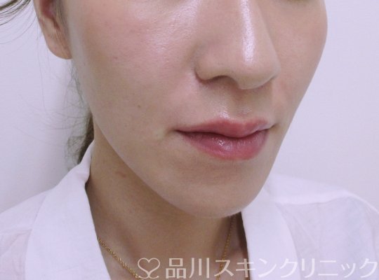 症例NO.65058のAFTER写真