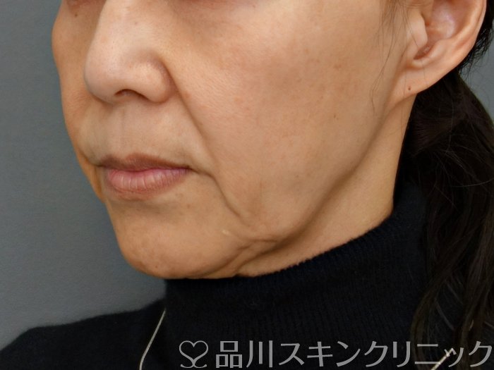 症例NO.74164のBEFORE写真