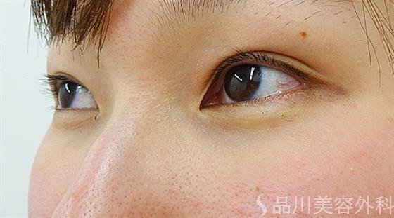 症例NO.36176のAFTER写真