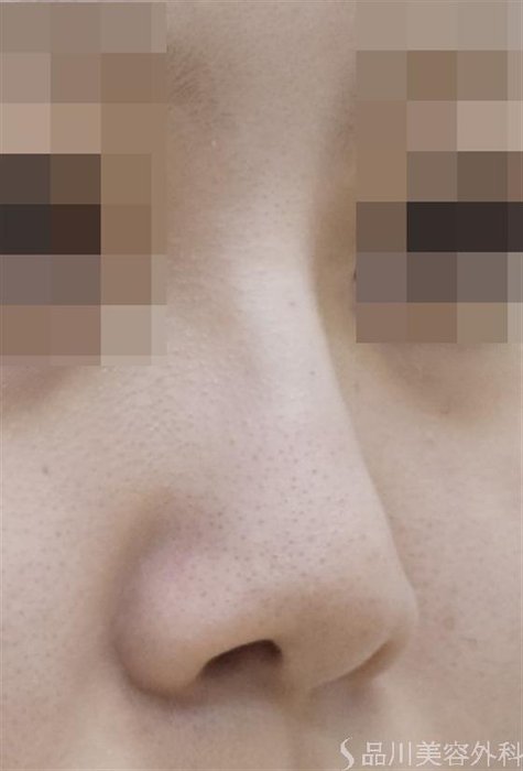 症例NO.54368のAFTER写真