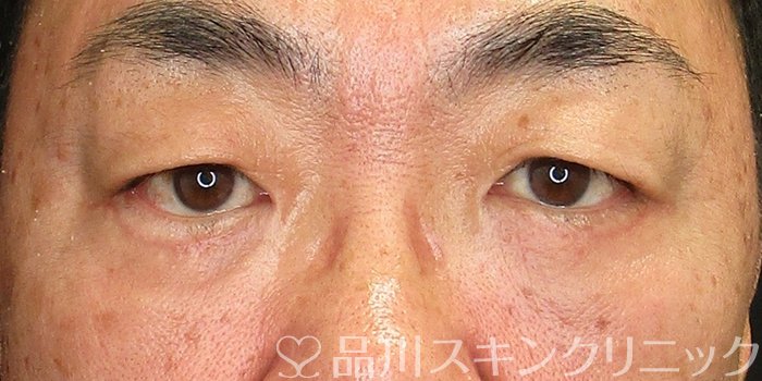 症例NO.73079のAFTER写真