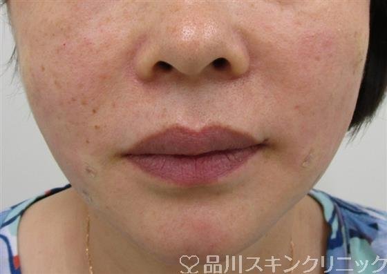 症例NO.37445のAFTER写真